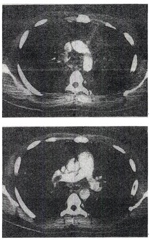 男，28岁，突发呼吸困难，结合图像，最可能的诊断是A.右上肺大叶性肺炎B.右上肺奇叶C.右主肺动脉栓