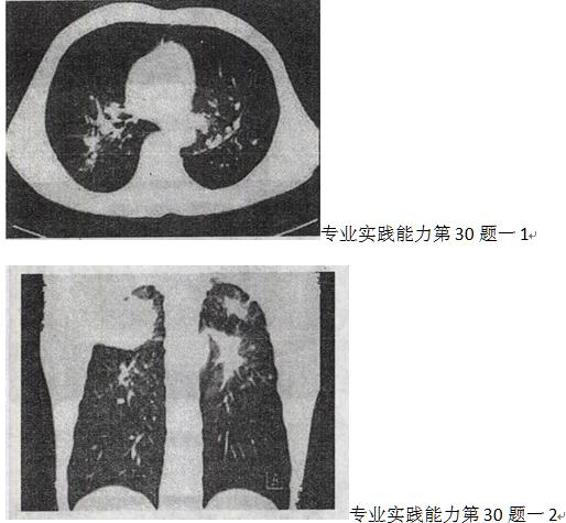 患者男，55岁，呼吸困难，气喘，查体桶状胸体症，CT如图，最可能的诊断是A.双上肺结核B.左上患者男