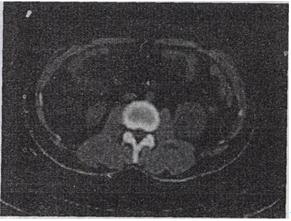 女，63岁，左腰部隐痛不适1个月余，CT平扫＋增强如图所示，最可能的诊断是A.左肾下极囊肿 B.女，