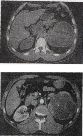 女，48岁，左腰部胀痛不适2个月余，根据所示图像，最可能的诊断是A.左侧囊性肾癌 B.左侧肾女，48