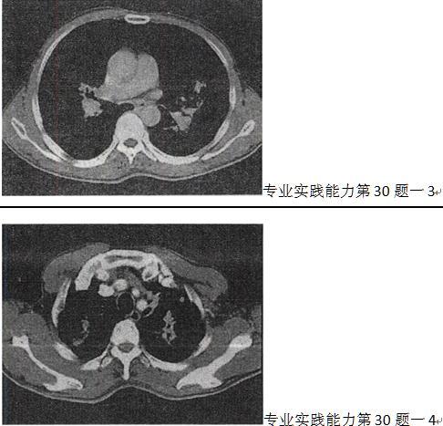 患者男，55岁，呼吸困难，气喘，查体桶状胸体症，CT如图，最可能的诊断是A.双上肺结核B.左上患者男
