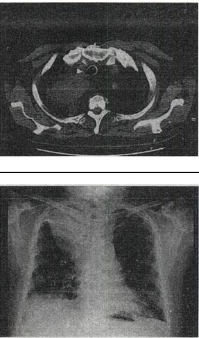 患者男，71岁，消瘦、咳嗽、胸痛，结合胸片和CT，最可能的诊断是A.脂肪肉瘤 B.心包脂肪垫 C.脂
