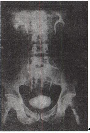 患者，男，36岁。下腰部不适半年，加重2周。静脉尿路造影见图。最可能为何诊断A.膀胱癌B.膀胱患者，