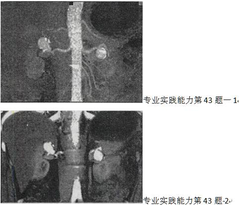 男，32岁，偶然发现有高血压，结合所示图像，最可能的诊断是A.双侧肾动脉瘤 B.双侧假性肾动男，32