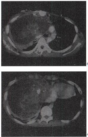 患者男，37岁，咳嗽，咯血2个月余，偶尔咳出钙化物，结合影像学检查，最可能的诊断是A.畸胎瘤 B.肺