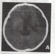 男性，12岁。智力低下、言语障碍11年CT检查如图所示，请根据CT图像给出正确诊断 A.蛛网膜囊肿B