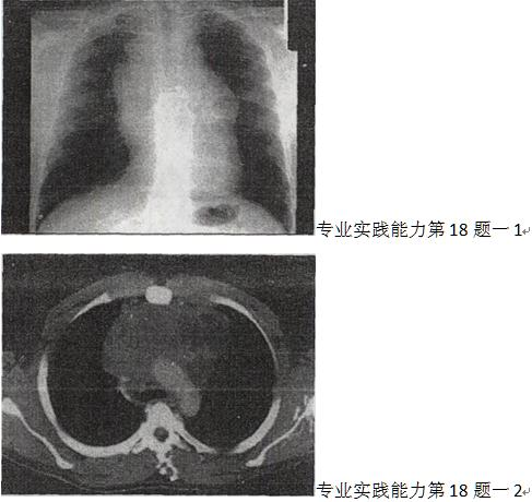 患者男，17岁，发现颈部肿块1个月，胸片检查、CT检查如图，最可能的诊断为A.胸腺瘤B.畸胎瘤患者男