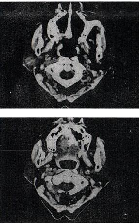 女，72岁，6年前于右面颊部扪及一包块，缓慢增大，其表面较光滑，CT如图所示，该病例应诊断为A.Wo