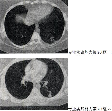 患者男，30岁，偶尔干咳，结合图像，最可能的诊断是A.左下肺感染 B.左下肺结核C.患者男，30岁，