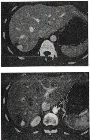 偶然在一个能作为肾移植供体的人的CT上发现病变，结合图像，最可能的诊断是A.肝细胞瘤B.偶然在一个能