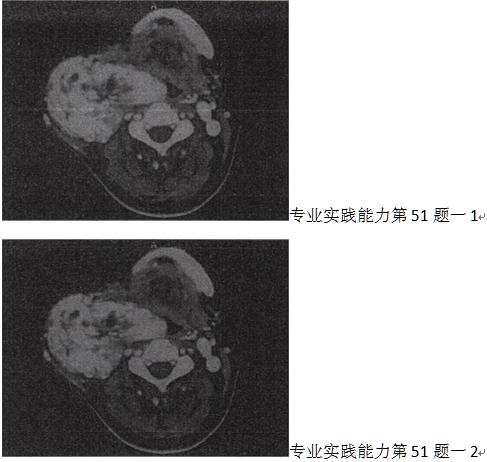 男，45岁，颈部渐进性增大包块，CT增强扫描如图所示，最可能的诊断是A.颈部肿大淋巴结B.颈男，45