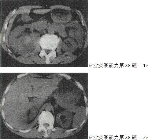 男，25岁，右腰部疼痛伴血尿，有外伤史，CT扫描如图所示，应诊断为A.右肾挫伤并包膜下血肿 B男，2