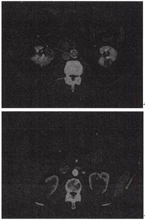男，54岁，无痛性血尿1个月余，根据所示图像，最可能的诊断是A.多发性肾囊肿B.多囊肾C.左侧肾癌并