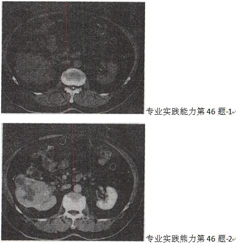 患者，男，51岁。右肾区不适4个月余，有镜下血尿。CT扫描结果见图。最有可能的诊断是A.肾癌B.患者