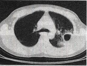 患者男，25岁，咳嗽，咯血近1周，午后低热1个月余，CT检查如图。 如图所示，患者左侧肺部为何种基本