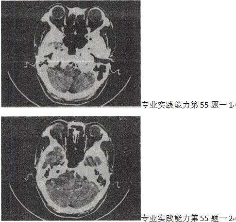 女，45岁，右耳听力下降半年余，CT检查如图，最可能的诊断是 A.继发性胆脂瘤 B.脑膜瘤C.三叉神