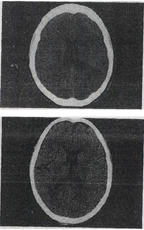 男，53岁，头部不适，结合CT检查，最可能的诊断是A.胶质瘤 B.脑积水C.第五脑室形男，53岁，头