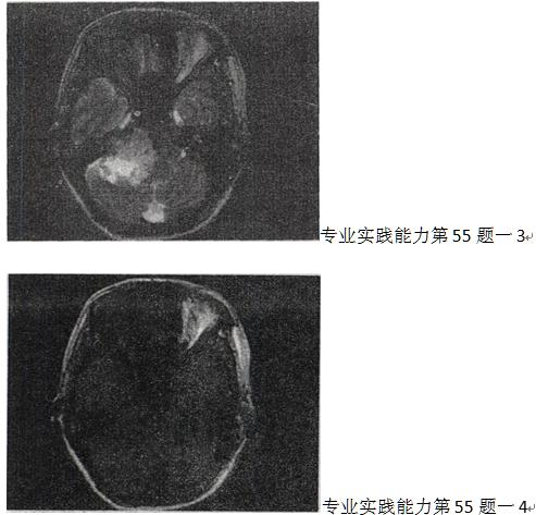 女，45岁，右耳听力下降半年余，CT检查如图，最可能的诊断是 A.继发性胆脂瘤 B.脑膜瘤C.三叉神
