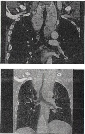 患者男，67岁，呼吸困难半年余，结合影像学检查，最可能的诊断是A.胸骨后甲状腺肿B.淋巴瘤C.间皮囊