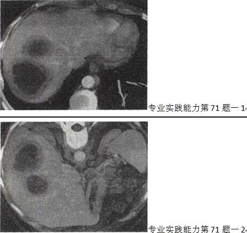 男，41岁，发热、右季肋部疼痛10余天，根据CT图像，最可能的诊断是A.肝癌 B.阿米巴肝脓肿C.肝