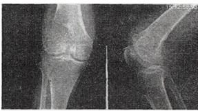男，30岁，右膝关节酸胀，疼痛不适5个月，X线检查如图所示，最可能的诊断是专业实践能力第3题A.骨巨