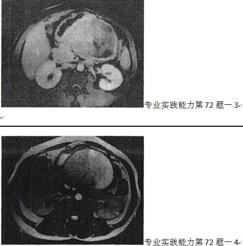 男，36岁，腹胀、消化不良、消瘦、中上腹痛，影像检查如下图，最可能的诊断是 A.胃间质肉瘤并肝转移 