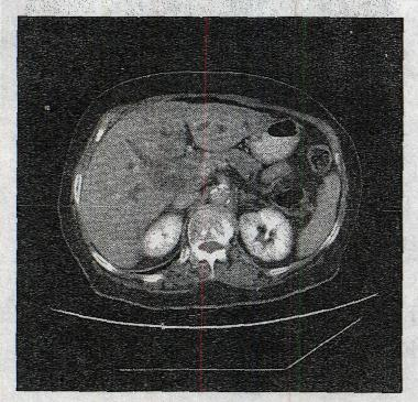 女，62岁。上腹不适、黄疸1个月，CT 检查如图。 胆系梗阻位置为A.胆总管下端B.胆总管中段C.壶