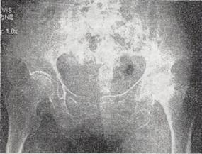 男，38岁，左髋关节疼痛跛行1年半，经治疗无明显好转，双髋关节正位片摄片如图所示，最可能诊断是专业男
