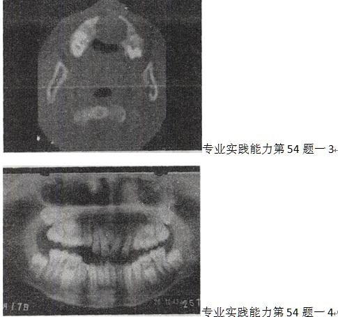 牙齿参差不齐，无发热，无疼痛，PE：上牙槽向前隆突，影像检查如图，最可能诊断为 A.上颌骨结核B.上