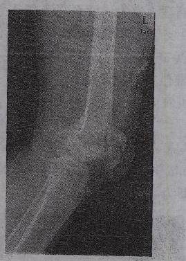 患者，男，24岁。外伤后膝部活动受限，肿胀疼痛。摄左膝部侧位X线片如图所示，影像学诊断为A.膝关节脱