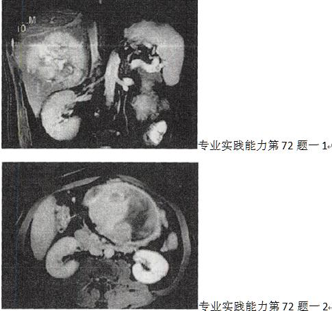 男，36岁，腹胀、消化不良、消瘦、中上腹痛，影像检查如下图，最可能的诊断是 A.胃间质肉瘤并肝转移 