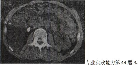 患者，女，48岁。反复血尿伴右侧腰痛7个月。CT扫描图像见图。最有可能的诊断是A.肾囊肿B.肾患者，