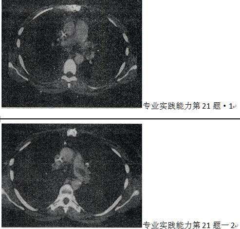 患者女，51岁，心脏手术后，突感胸痛，结合CT图像，最可能的诊断是A.肺栓塞 B.支气管扩张C.肺水