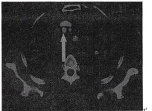 箭头所指的解剖结构是基础知识第62题A.右颈总动脉B.右锁骨下动脉C.右无名静脉箭头所指的解剖结构是