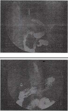 男，38岁，口干，多饮多尿消瘦2个月，结合图像，最可能的诊断为A.未见异常表现B.胃憩室C.胃溃疡D