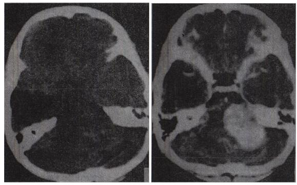 女性，43岁。左侧听力下降伴左侧面部不适7个月，根据CT图像（见图)，最可能的诊断是女性，43岁。左