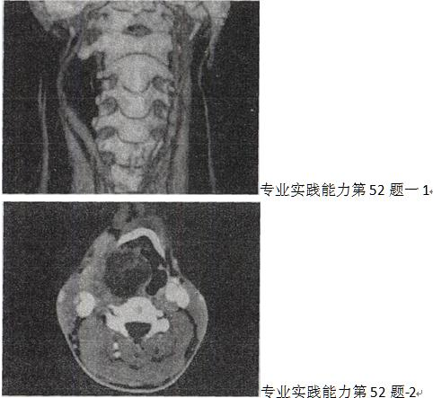 男，41岁，右侧咽部不适2年余，有异物感，声音嘶哑，CT如图，最可能的诊断是A.颈动脉体瘤 B.男，