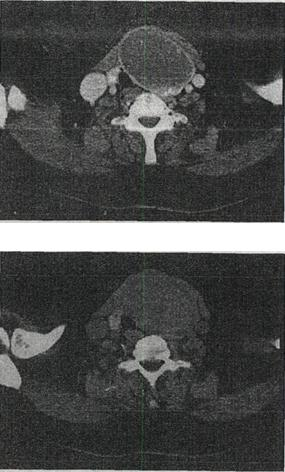 女，56岁，发现颈部肿块l个月余，CT如图所示，最可能的诊断是A.甲状舌管囊肿B.甲状腺乳头状女，5