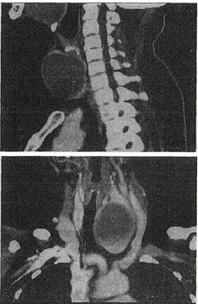 女，56岁，发现颈部肿块l个月余，CT如图所示，最可能的诊断是A.甲状舌管囊肿B.甲状腺乳头状女，5
