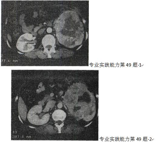 患者，女，58岁。左腰部不适，血尿2个月余。CT检查见图。最有可能的诊断是A.肾癌B.肾盂癌C.肾错