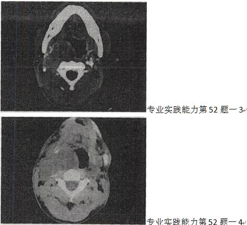 男，41岁，右侧咽部不适2年余，有异物感，声音嘶哑，CT如图，最可能的诊断是A.颈动脉体瘤 B.男，