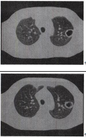患者女，49岁，午后低热，咳嗽2个月余，结合影像学检查，最可能的诊断是A.肺癌B.肺结核C.肺脓肿D