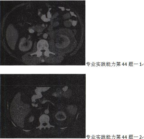 男，65岁，全身浅表淋巴结肿大，根据所示图像，最可能的诊断是A.左侧肾癌 B.左肾转移癌C.巴瘤左肾