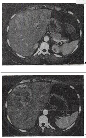 女，65岁，肝区疼痛1个月余,CT检查如图，最可能的诊断是A.原发性肝癌 B.肝转移癌女，65岁，肝