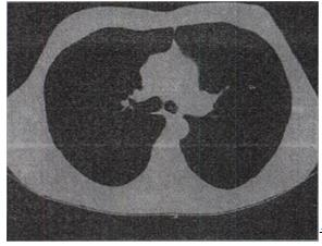 患者男,55岁，胸闷气急1周，无发热，结合图像，最可能的诊断是A.右侧气胸B.肺气肿并双侧肺患者男,