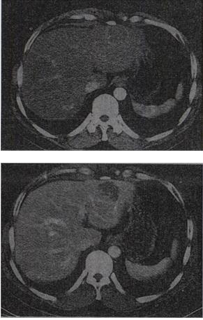 男，54岁，8超体检示肝左叶强回声团块影，CT表现如图，最可能的诊断是A.肝癌B.肝腺瘤C.肝母细胞