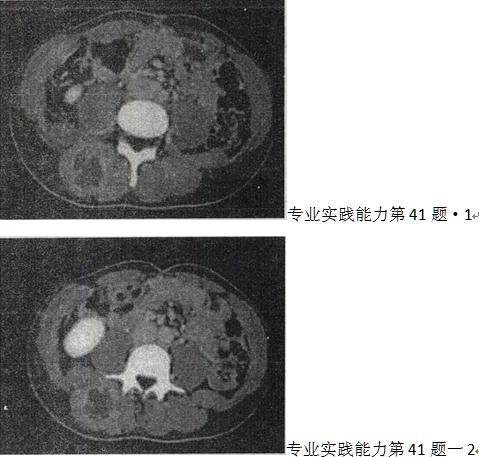 女，28岁，右肾区疼痛伴高热，根据所示图像，最可能的诊断是A.右肾结石B.右侧输尿管上段结女，28岁