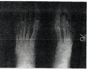 男性，56岁，发现右足第一跖趾关节反复突发性红、肿、热、剧痛5年余，行右足摄片，如图所示，最可能的诊