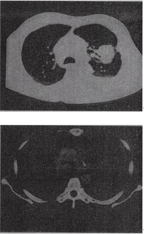 患者，女，68岁，咳嗽伴胸痛胸闷1个月，CT检查如图，最可能的诊断为A.左上肺不张B.左上肺周患者，