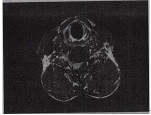 男，54岁，四肢乏力伴麻木不适半年，根据所提供图像，最可能的诊断是A.星形细胞瘤 B.神经源男，54